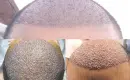 Où faire une greffe de cheveux ?