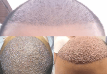 Où faire une greffe de cheveux ?