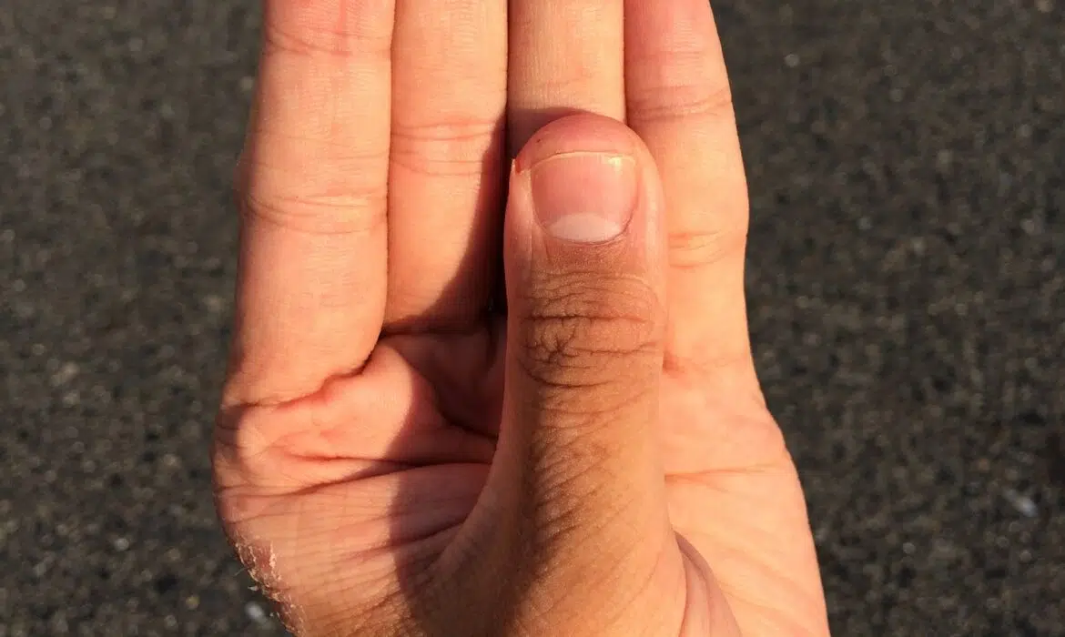 Comment soigner un panaris au doigt naturellement ?