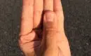 Comment soigner un panaris au doigt naturellement ?