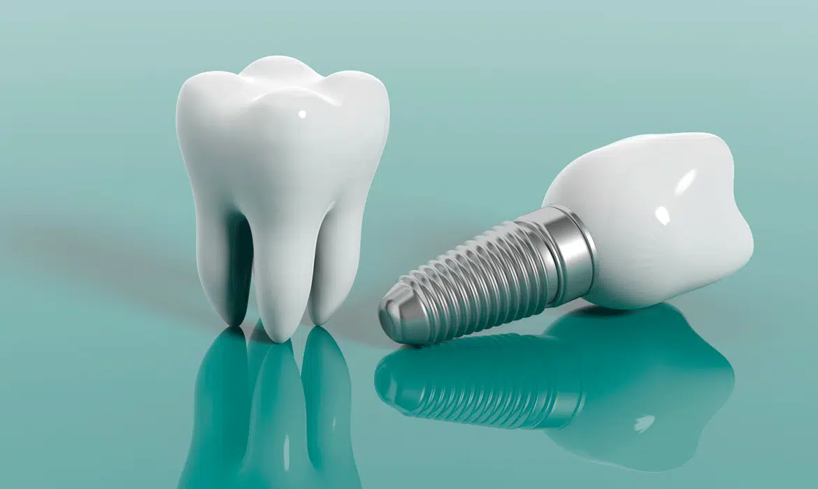 Comment faire pour ne pas payer un implant dentaire?
