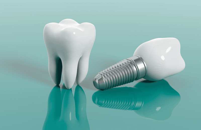 Comment faire pour ne pas payer un implant dentaire?